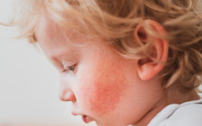 Four Natural Remedies For Eczema